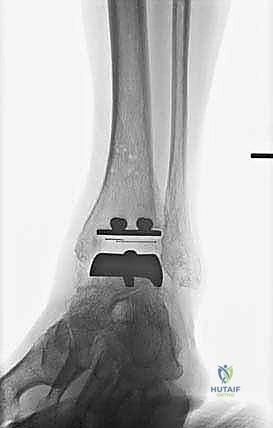 صورة طبية: استبدال مفصل الكاحل الكلي ستار STAR لعلاج خشونة الكاحل المتقدمة في صنعاء
