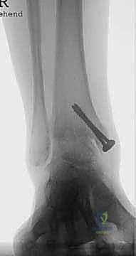 صورة طبية: مفصل الكاحل الصناعي الكلي HINTEGRA: استعادة الحركة والتخلص من الألم مع الأستاذ الدكتور محمد هطيف في صنعاء