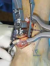 تحديد مركز المفصل