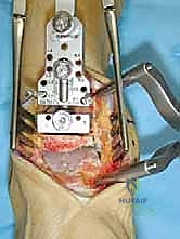 تجهيز سطح عظم الكاحل