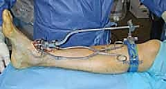 القياسات الدقيقة أثناء الجراحة