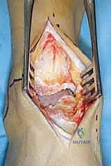 ضبط زوايا القطع العظمي