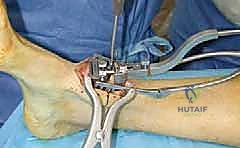 إزالة الزوائد العظم
![صورة طبية: مفصل الكاحل الصناعي الكلي HINTEGRA: استعادة الحركة والتخلص من الألم مع الأستاذ الدكتور محمد هطيف في صنعاء