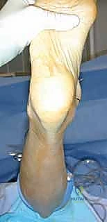 صورة طبية: مفصل الكاحل الصناعي الكلي HINTEGRA: استعادة الحركة والتخلص من الألم مع الأستاذ الدكتور محمد هطيف في صنعاء