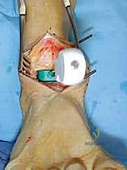 صورة شعاعية قبل الجراحة