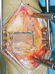 صورة توضيحية لـ مفصل الكاحل الصناعي الكلي HINTEGRA: استعادة الحركة والتخلص من الألم مع الأستاذ الدكتور محمد هطيف في صنعاء