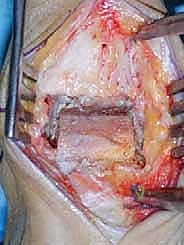 صورة طبية: مفصل الكاحل الصناعي الكلي HINTEGRA: استعادة الحركة والتخلص من الألم مع الأستاذ الدكتور محمد هطيف في صنعاء