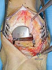 صورة طبية: مفصل الكاحل الصناعي الكلي HINTEGRA: استعادة الحركة والتخلص من الألم مع الأستاذ الدكتور محمد هطيف في صنعاء