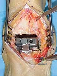 صورة توضيحية لـ مفصل الكاحل الصناعي الكلي HINTEGRA: استعادة الحركة والتخلص من الألم مع الأستاذ الدكتور محمد هطيف في صنعاء