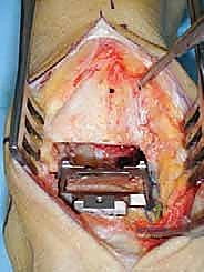 صورة توضيحية لـ مفصل الكاحل الصناعي الكلي HINTEGRA: استعادة الحركة والتخلص من الألم مع الأستاذ الدكتور محمد هطيف في صنعاء