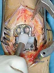 صورة توضيحية لـ مفصل الكاحل الصناعي الكلي HINTEGRA: استعادة الحركة والتخلص من الألم مع الأستاذ الدكتور محمد هطيف في صنعاء