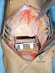 إبعاد الأنسجة الرخوة
