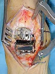 صورة توضيحية لـ مفصل الكاحل الصناعي الكلي HINTEGRA: استعادة الحركة والتخلص من الألم مع الأستاذ الدكتور محمد هطيف في صنعاء
