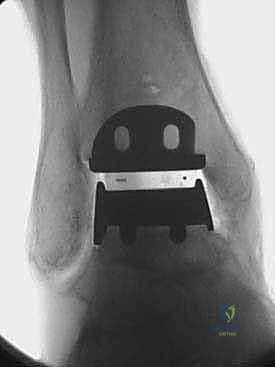 صورة طبية: مفصل الكاحل الصناعي الكلي HINTEGRA: استعادة الحركة والتخلص من الألم مع الأستاذ الدكتور محمد هطيف في صنعاء