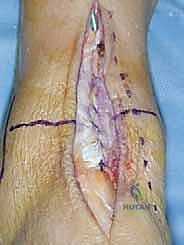 صورة طبية: مفصل الكاحل الصناعي الكلي HINTEGRA: استعادة الحركة والتخلص من الألم مع الأستاذ الدكتور محمد هطيف في صنعاء