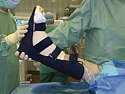 صورة توضيحية لـ مفصل الكاحل الصناعي الكلي HINTEGRA: استعادة الحركة والتخلص من الألم مع الأستاذ الدكتور محمد هطيف في صنعاء