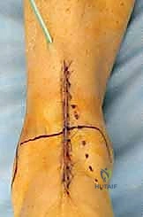 صورة توضيحية لـ مفصل الكاحل الصناعي الكلي HINTEGRA: استعادة الحركة والتخلص من الألم مع الأستاذ الدكتور محمد هطيف في صنعاء