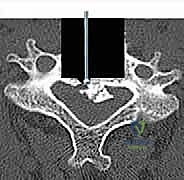 الأسباب المؤدية لانضغاط النخاع الشوكي العنقي