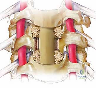 استئصال جسم الفقرة وتحرير الحبل الشوكي
