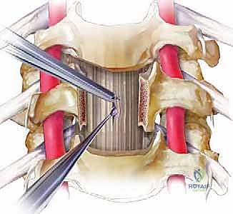 الوصول إلى العمود الفقري العنقي من الجهة الأمامية