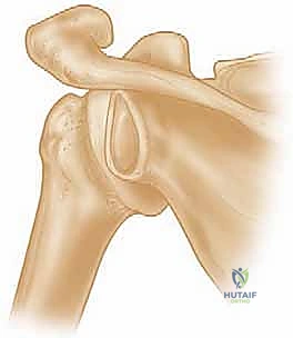 Illustration of engaging hillsachs lesion - Dr. Mohammed Hutaif
