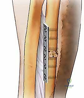 الأستاذ الدكتور محمد هطيف أثناء إجراء تدخل جراحي دقيق لعلاج عدم التئام كسر الساعد