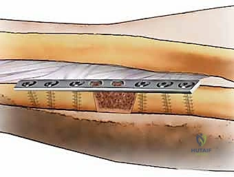 فهم وعلاج عدم التئام كسور الساعد: دليل شامل للمرضى مع الأستاذ الدكتور محمد هطيف