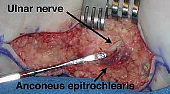 Illustration of cubital tunnel syndrome - Dr. Mohammed Hutaif