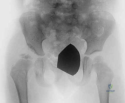 صورة توضيحية لـ جراحات تصحيح تشوه مفصل الورك للأطفال (خلع الورك التطوري): تقنيات بيمبرتون وديجا