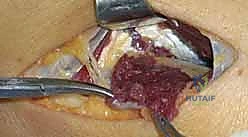 Radial Nerve Decompression: An Intraoperative Masterclass for Posterior Interosseous Nerve Entrapment