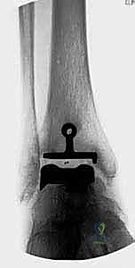 صورة طبية: استبدال مفصل الكاحل الكلي بنظامي سالتو وسالتو تالاريس: دليل شامل من الأستاذ الدكتور محمد هطيف