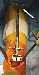 صورة أشعة سينية متقدمة تظهر انعدام المسافة الغضروفية واحتكاك العظام