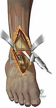 توضيح لدرجات تآكل الغضروف في مفصل الكاحل