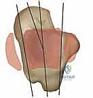 صورة طبية: استبدال مفصل الكاحل الكلي بنظامي سالتو وسالتو تالاريس: دليل شامل من الأستاذ الدكتور محمد هطيف