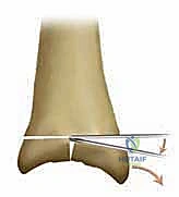 صورة طبية: استبدال مفصل الكاحل الكلي بنظامي سالتو وسالتو تالاريس: دليل شامل من الأستاذ الدكتور محمد هطيف