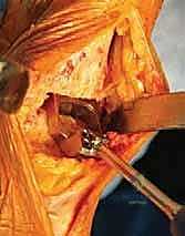 صورة توضيحية لـ استبدال مفصل الكاحل الكلي بنظامي سالتو وسالتو تالاريس: دليل شامل من الأستاذ الدكتور محمد هطيف