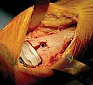 صورة توضيحية لـ استبدال مفصل الكاحل الكلي بنظامي سالتو وسالتو تالاريس: دليل شامل من الأستاذ الدكتور محمد هطيف