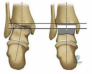 صورة توضيحية لـ استبدال مفصل الكاحل الكلي بنظامي سالتو وسالتو تالاريس: دليل شامل من الأستاذ الدكتور محمد هطيف