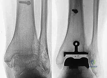 صورة توضح بعض أدوات العلاج الطبيعي والتحفظي للكاحل