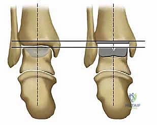 صورة تفصيلية لمكونات مفصل سالتو تالاريس ذي المكون الثابت
