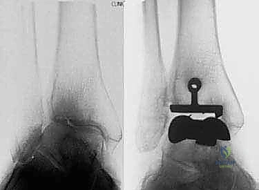 صورة طبية: استبدال مفصل الكاحل الكلي بنظامي سالتو وسالتو تالاريس: دليل شامل من الأستاذ الدكتور محمد هطيف