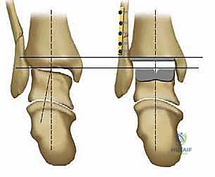 صورة طبية: استبدال مفصل الكاحل الكلي بنظامي سالتو وسالتو تالاريس: دليل شامل من الأستاذ الدكتور محمد هطيف