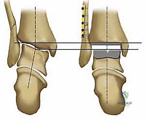 صورة طبية: استبدال مفصل الكاحل الكلي بنظامي سالتو وسالتو تالاريس: دليل شامل من الأستاذ الدكتور محمد هطيف