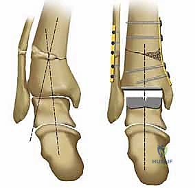 الأستاذ الدكتور محمد هطيف أثناء فحص دقيق لحالة كاحل معقدة