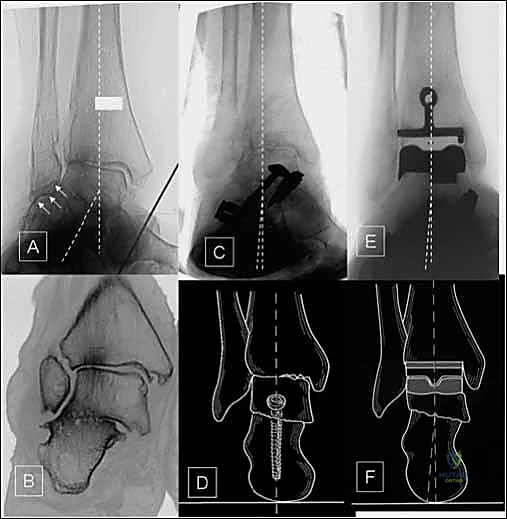 صورة شعاعية طبيعية لمفصل الكاحل توضح المسافات الغضروفية