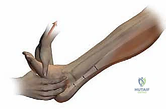 صورة تظهر التشوه الناتج عن التهاب المفاصل الروماتويدي المتقدم