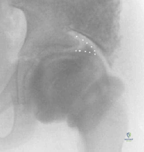 Illustration of labral support shelf - Dr. Mohammed Hutaif