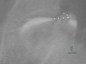 خطوات التحضير الجراحي لجراحة الرفرف