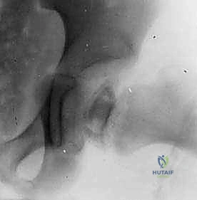 صورة توضح الإغلاق النهائي للجرح