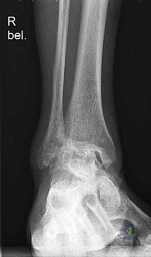 استبدال مفصل الكاحل الكلي